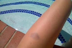 LegBruise2011