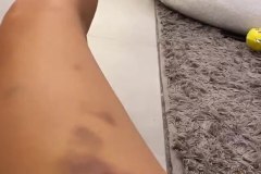 FightTrainingBruises10-10-2020
